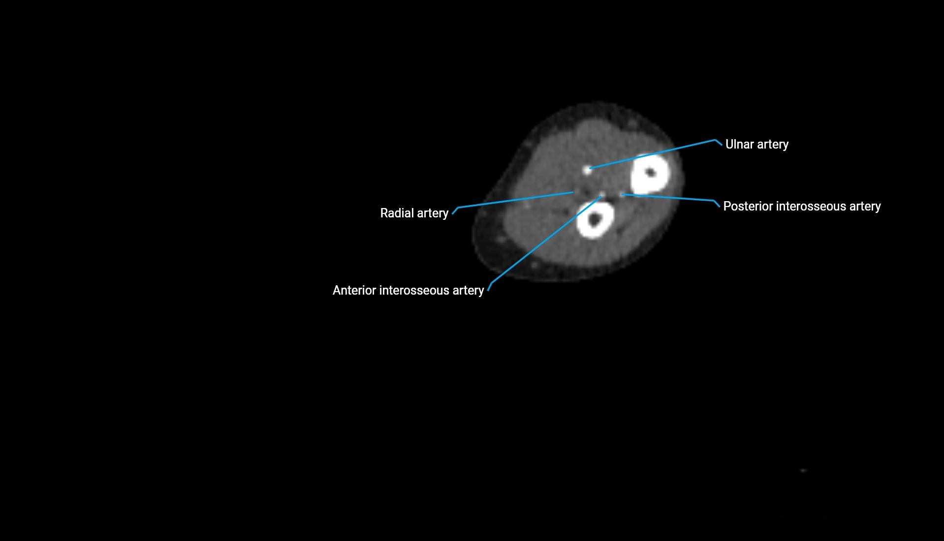 CTA upper limb axial cross sectional anatomy labelled image 159 (2).webp